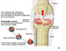 lesionmeniscos02