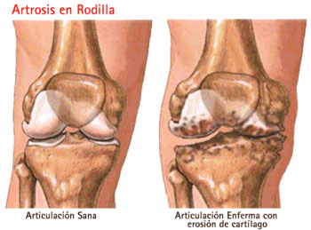 Rodilla con articulación enferma con erosión de cartílago