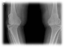 Radiografía de rodilla con desgaste articular