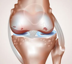 Daño de rodilla con lesiones condriales
