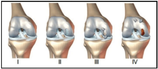 Grados de desgaste de cartílago en rodilla 