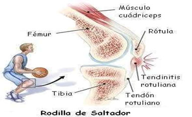 rodilladesaltador01