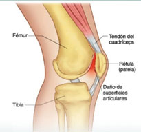 Imagen de rodilla con daño de superficie articulares