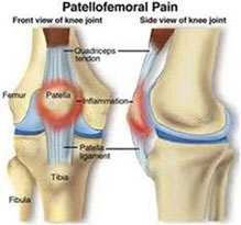 Imagen de rodilla con dolor peripatelar