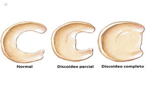 meniscodiscoide_clinicarehabilitacion01