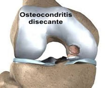 osteocondritis_01